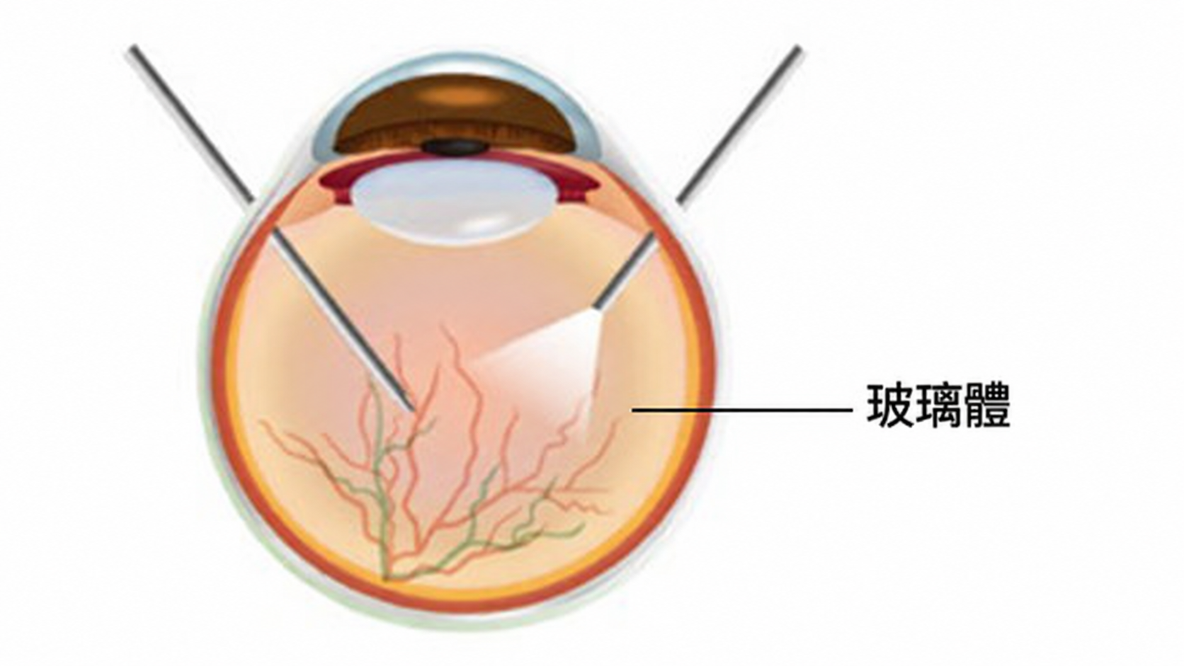玻璃體切除術示意