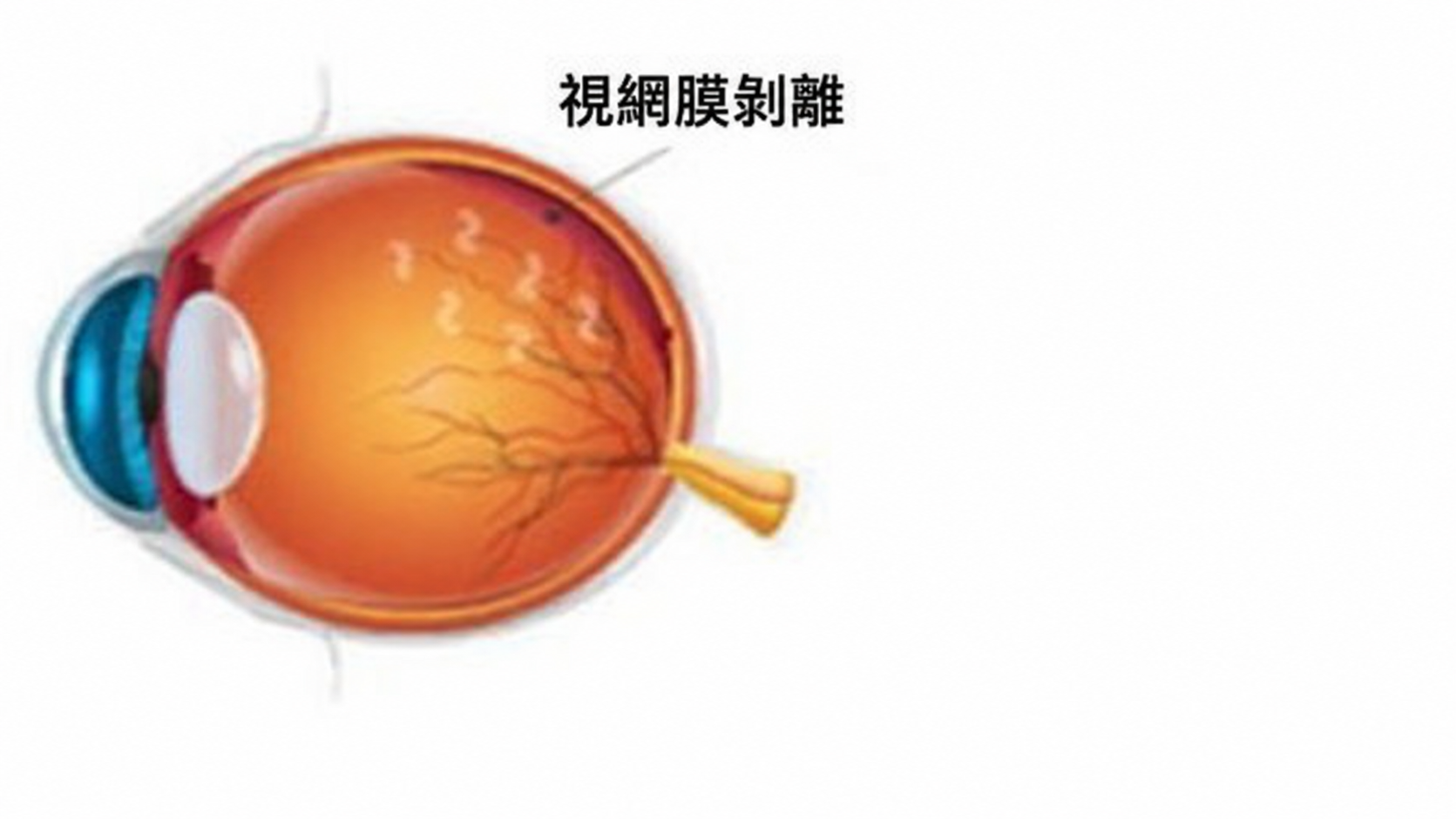 視網膜剝離的眼球示意