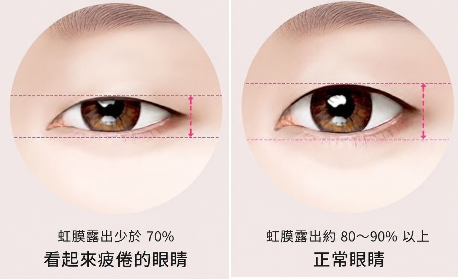 眼瞼覆蓋與虹膜露出比例的示意比較