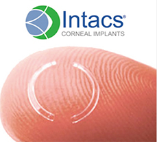 INTACS 角膜環：本院介紹的角膜基質內環植入治療選項。