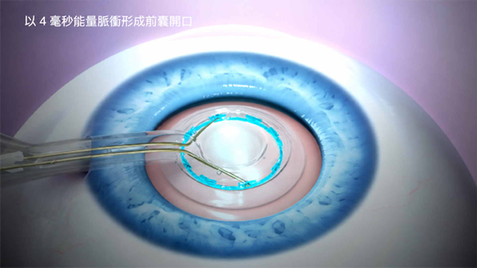 以精密脈衝形成水晶體前囊開口。